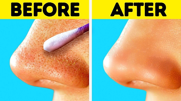 Simple And Effective Trick To Get Rid Of Blackheads!