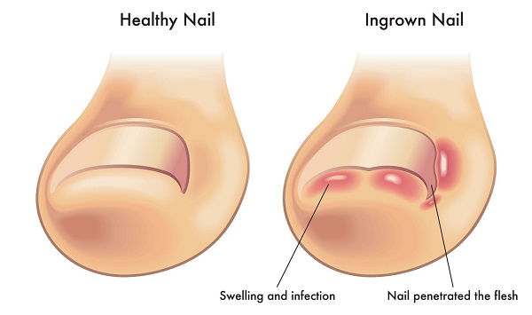 Treat Your Ingrown Toenail With These 6 Natural & Homemade Remedies