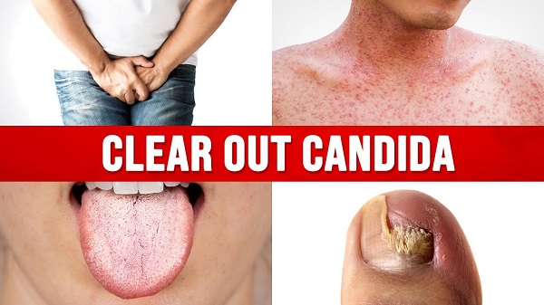 What Is Candida Overgrowth And How To Deal With It