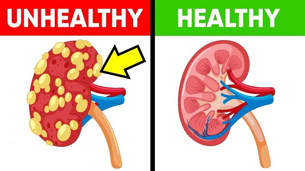 You Need A Kidney Cleanse Here’s How To Flush Out Toxins From Your Kidneys